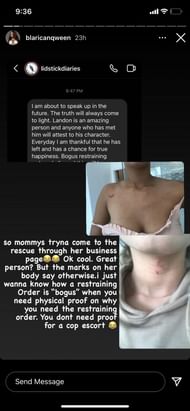 Bruises are seen on Shyla Walker's upper body, allegedly caused by Landon McBroom (Image via Instagram)